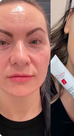 Reduce Scars with Cyto Derma